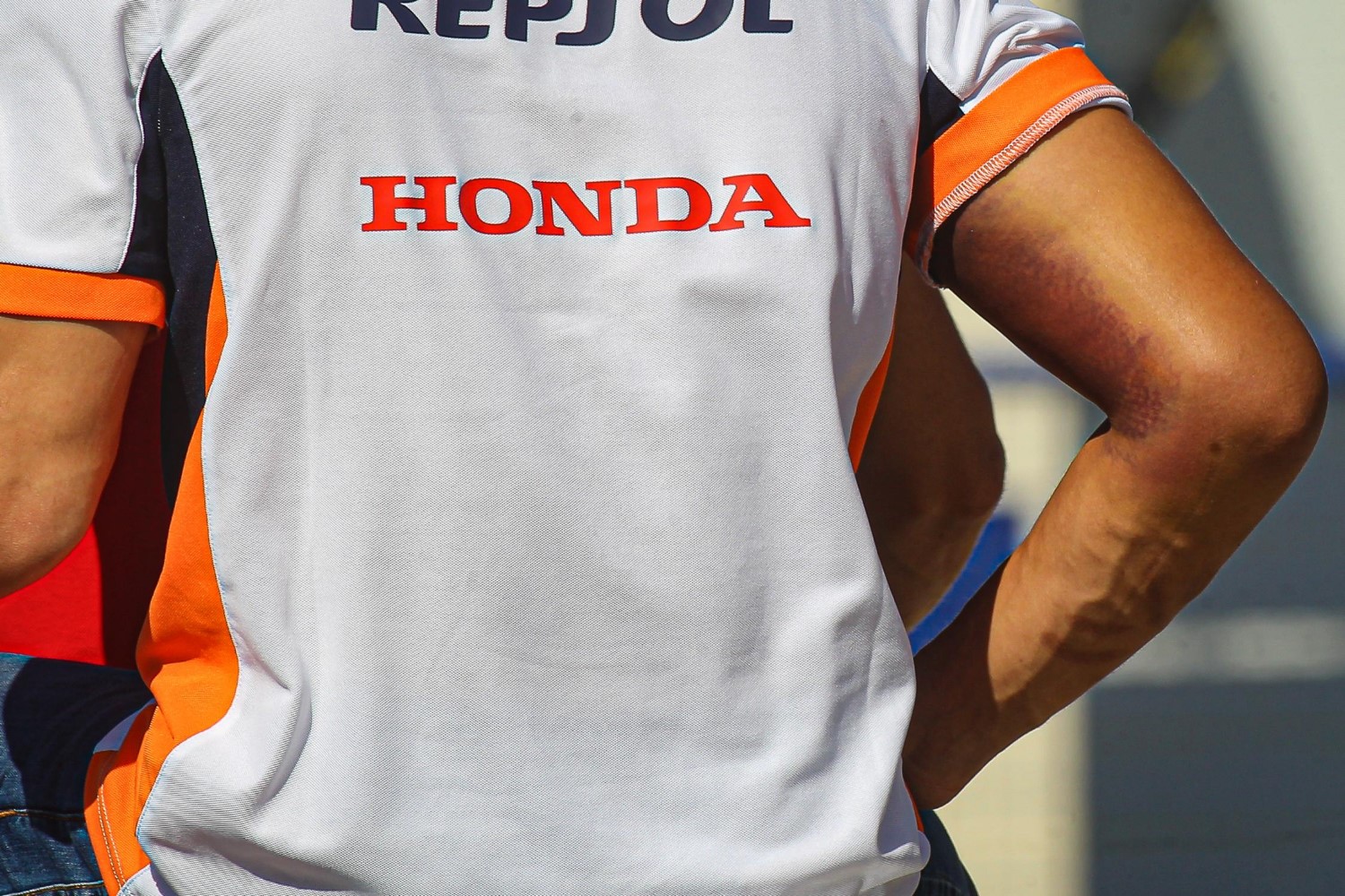 Note scars on Marquez's broken arm