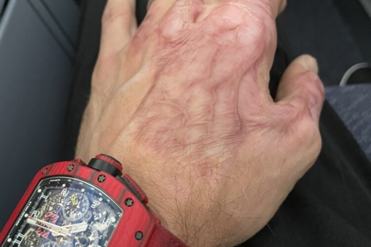 F1: New gloves to minimize Grosjean-like burns