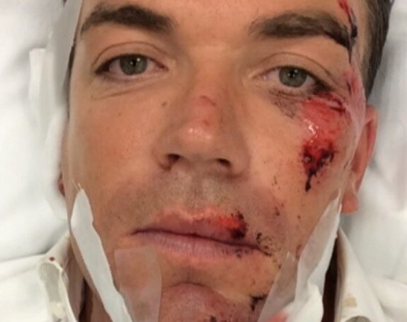 Robert Doornbos badly injured in a scooter accident in Amsterdam